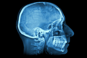 Photo of X-ray of patient's head